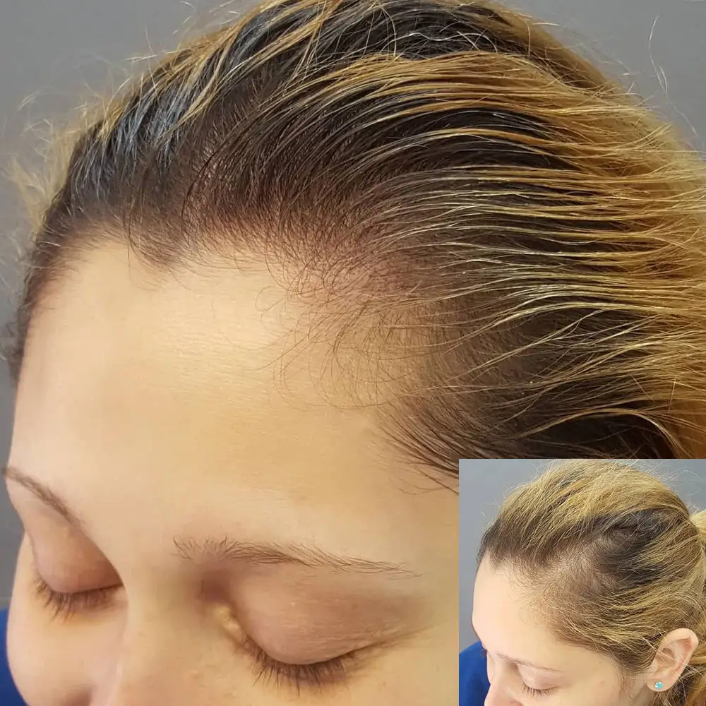 female-scalp-micropigmentation-before-and-after