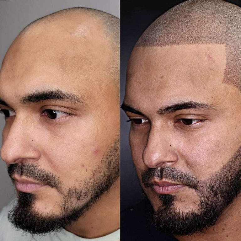hairline-restoration-01