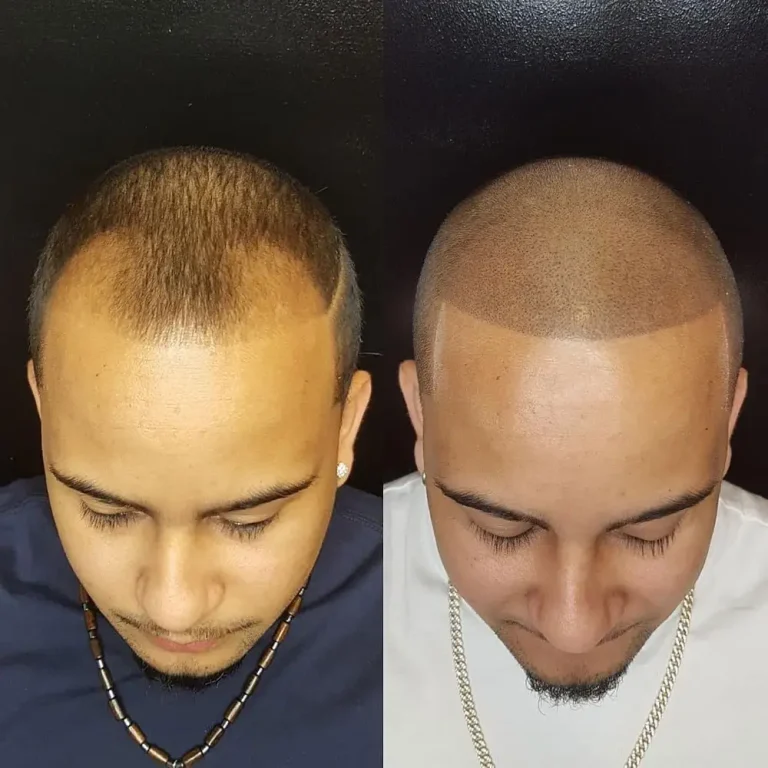 scalp-micropigmentation-before-and-after